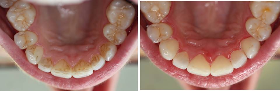 Teeth Whitening Aberdeen Teeth Whitening Dental Inspirations